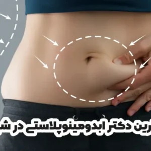 بهترین دکتر ابدومینوپلاستی در شیراز