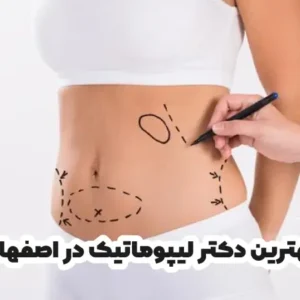 بهترین دکتر لیپوماتیک در اصفهان