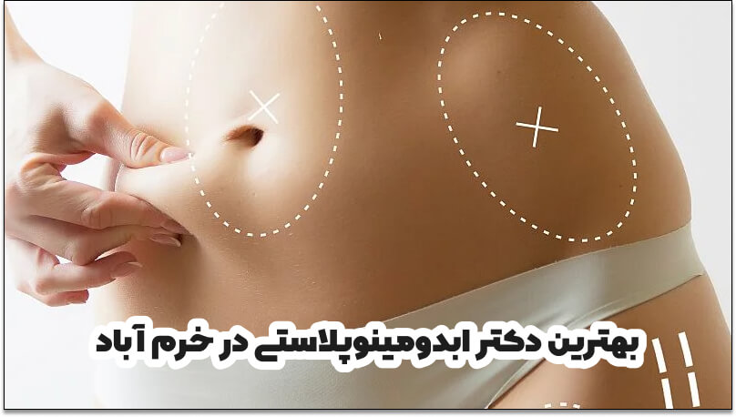 بهترین دکتر ابدومینوپلاستی در خرم آباد
