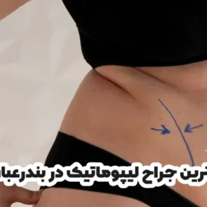 بهترین جراح لیپوماتیک در بندرعباس